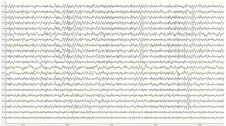 Second recording linked ears montage showing reference contamination in 20-25 Hz range